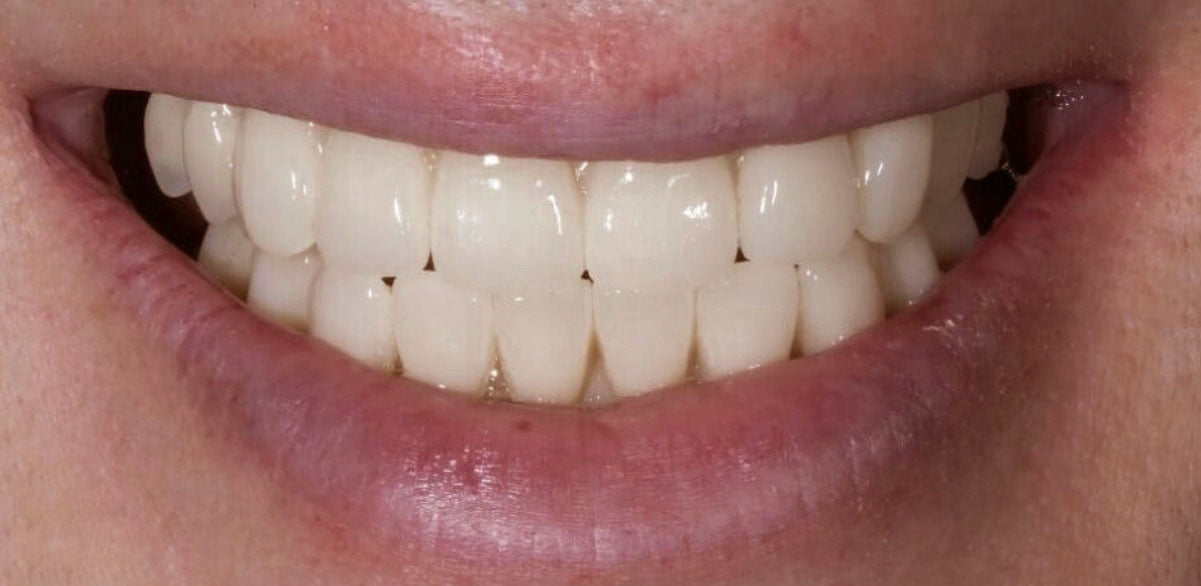 After image