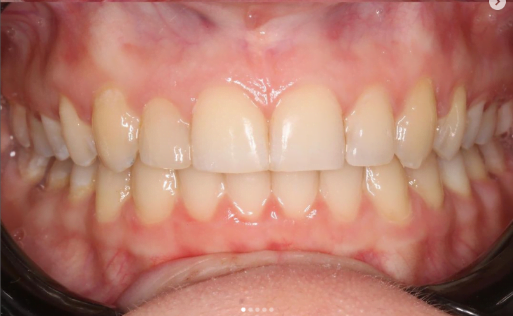 After image