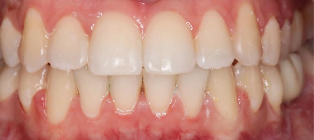 After image