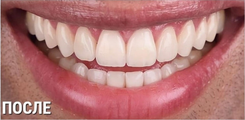 After image